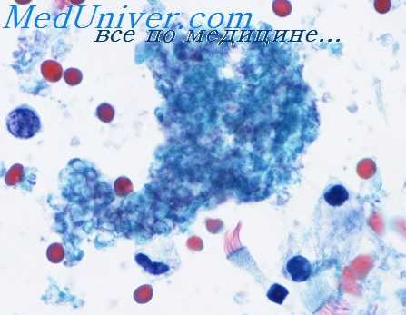 парагонимоз