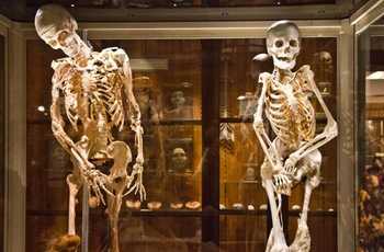 Прогрессирующая оссифицирующая фибродисплазия или болезнь Мюнхеймера - одно из самых редких заболеваний опорно-двигательного аппарата, вследствие которого происходит утрата дееспособности пациента за счет окостенения соединительных тканей и приводящее к преждевременной смерти больного. 