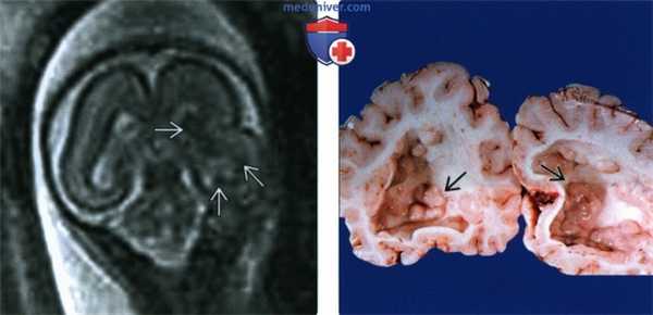 Лучевые признаки гетеротопии серого вещества головного мозга у плода