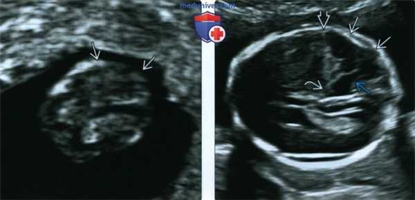 Лучевые признаки гетеротопии серого вещества головного мозга у плода