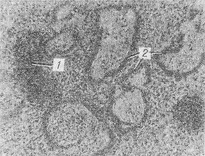 Рис. 1. Микропрепарат ткани легкого ребенка двух дней, умершего от гиалиновомембранной болезни новорожденных: в легких ателектазы (1) и гиалиновые мембраны (2); окраска гематоксилин-эозином.