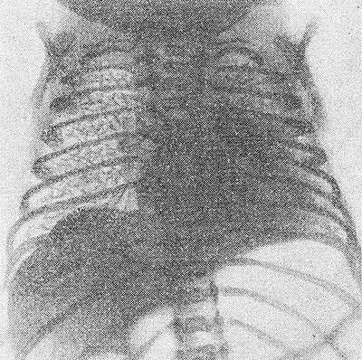 Рис. 2. Рентгенограмма грудной клетки ребенка 15 часов жизни, страдающего гиалиново-мембранной болезнью: на всем протяжении правого легкого видна характерная сетчатость легочного рисунка, ателектазы в левом легком.