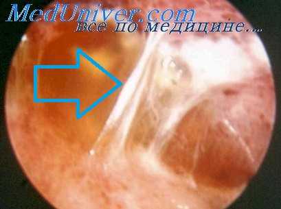 плевральные сращения