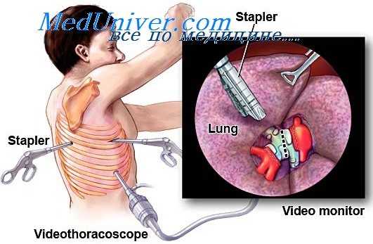 плевральные сращения