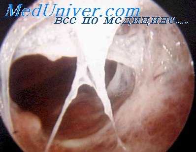 вылущивание плевральных спаек