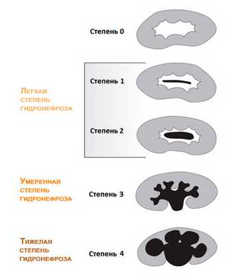 Степени гидронефроза