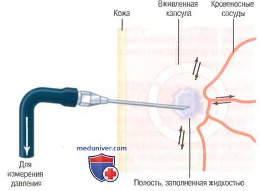 Гидростатическое давление интерстициальной жидкости