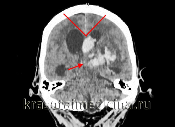 Гидроцефалия