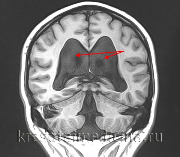 МРТ головного мозга. Выраженное расширение боковых желудочков окклюзионного характера.