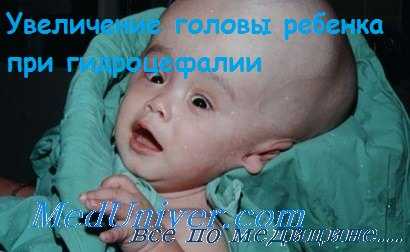 гидроцефалия