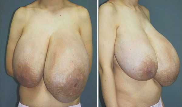 Гигантомастия