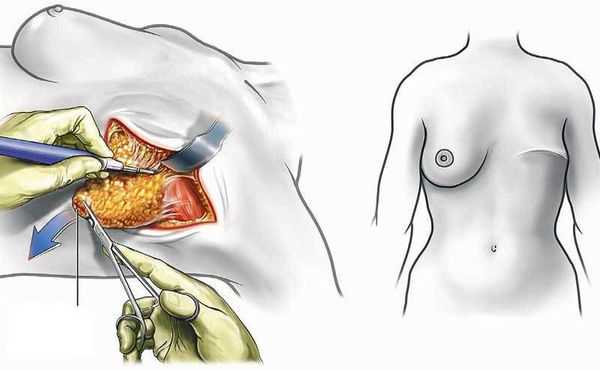 Мастэктомия 