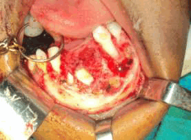 На фотографии до операции видно, что образование распространяется от медиальной части 83 до медиальной части 74