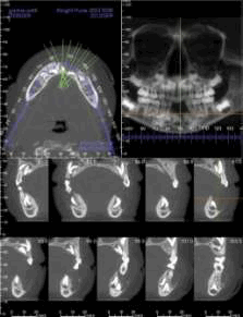 Конусно-лучевая компьютерная томограмма.