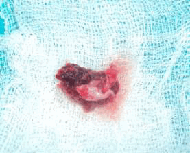 Гигантоклеточная гранулема у 4-летней девочки: клинический случай