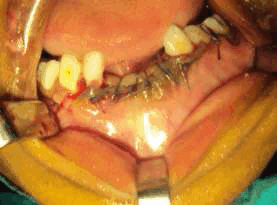 Наложение послеоперационного шва викрилом.