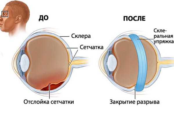 отслойка сетчатки