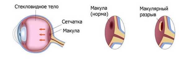 макулярный разрыв сетчатки