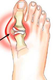 шишка-при-артрозе-г