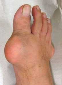 стопа-при-подагрическом-тофусе-1