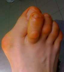 молоткообразная-деформация-3