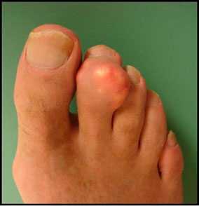 стопа-при-подагрическом-тофусе-2