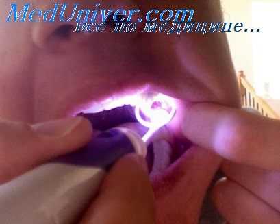 гингивэктомия