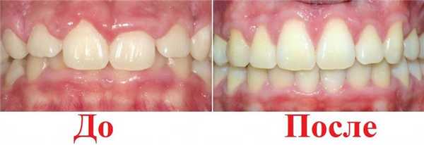 после операции гингивэктомии