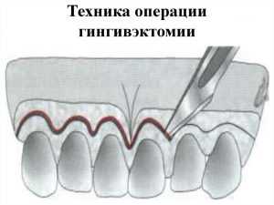 Техника операции гингивэктомии