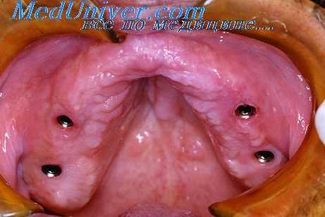 полость рта без зубов