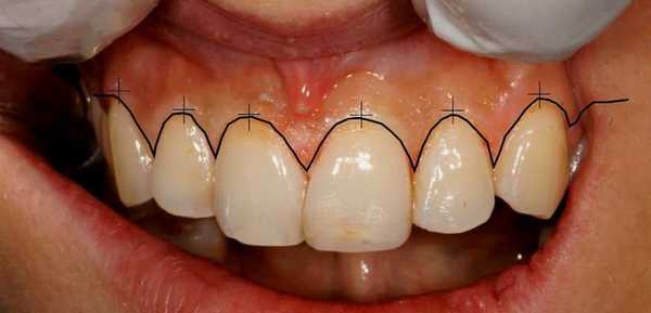 операция гингивэктомия