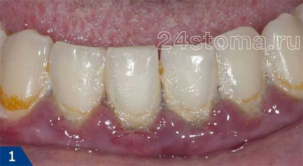 Хронический гингивит