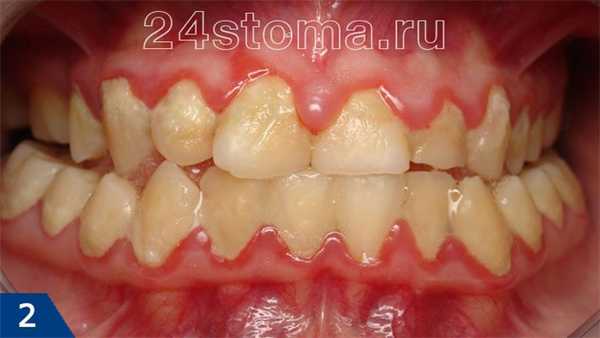 Катаральный гингивит. Массивные скопления мягкого зубного налета у шеек зубов, резкое покраснение краевой десны