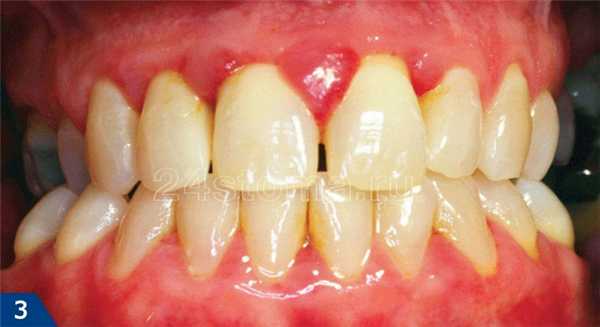 Катаральный гингивит при беременности