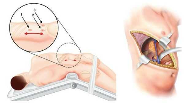 Эндоскопическая и открытая адреналэктомия