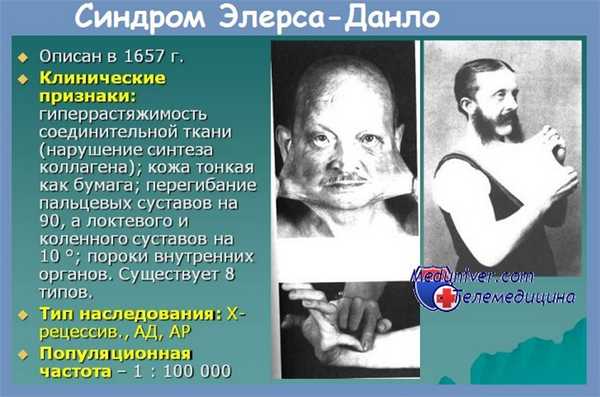 Синдром Элерса-Данло