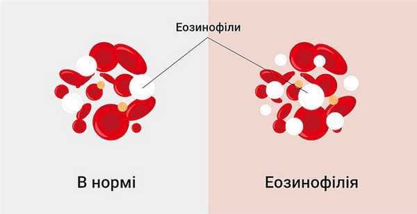 Патогенез эозинофилии