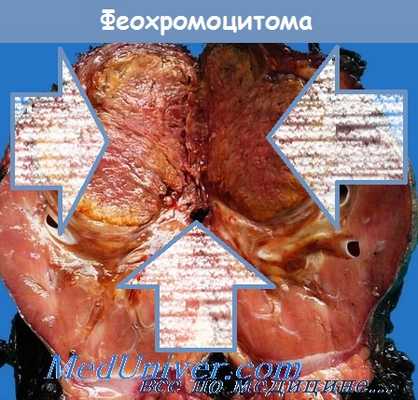 морфология феохромоцитомы