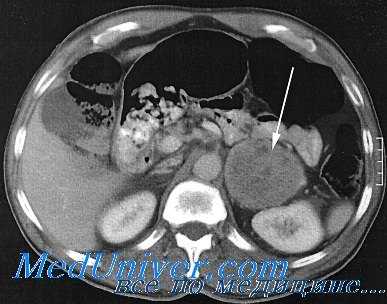 феохромоцитома