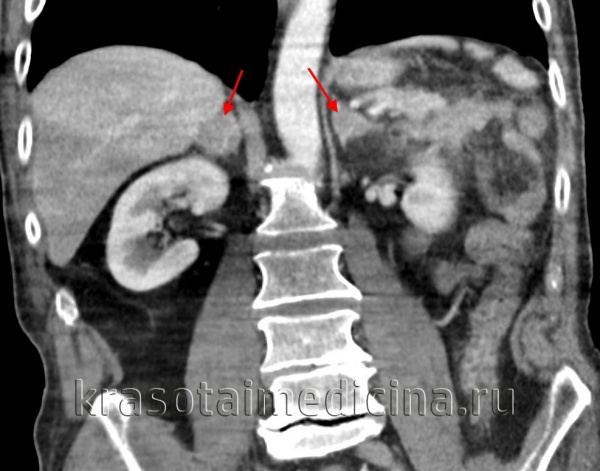 КТ ОБП/ЗП. Аденомы обоих надпочечников.