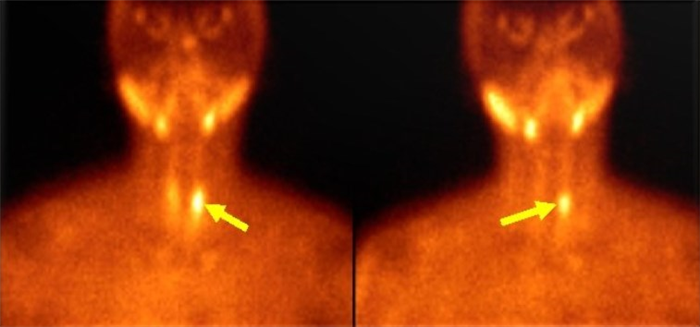 Сцинтиграфия. Аденома паращитовидной железы