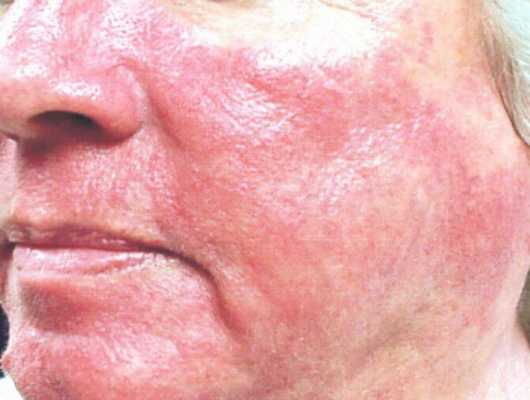 хобл по эмфизематозному типу