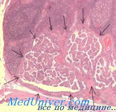 формы гиперпаратиреоза