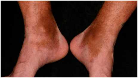 Посттравматическая гиперпигментация на ногах из-за повреждения сосудов