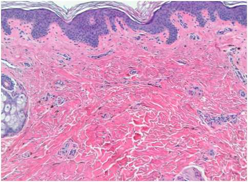 Глубокие пигментации - гистологические изменения