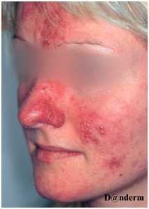 Посттравматические и поствоспалительные сосудистые дисхромии - розацеа