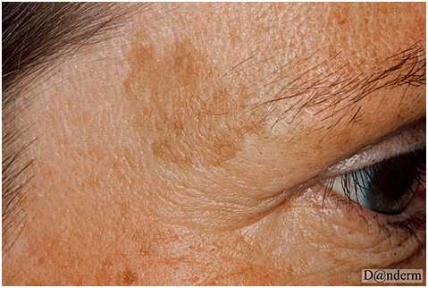 Глубокие пигментации - солнечное лентиго