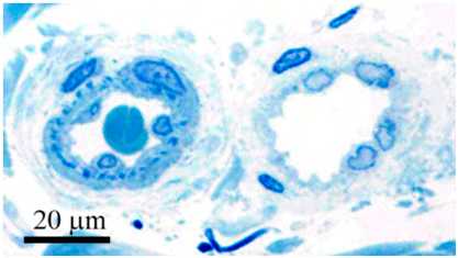 Посттравматические и поствоспалительные сосудистые дисхромии - биопсия кожи