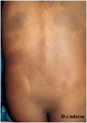 Глубокие пигментации - врожденный дермальный меланоз