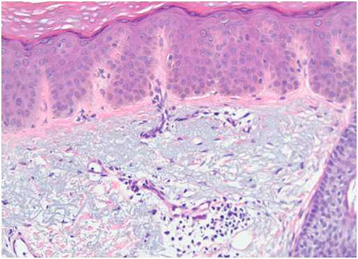 Глубокие пигментации - изменения при лентиго